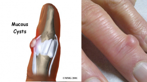 Mucous Cyst on The Fingers: Symptoms & Treatment – NailDesignCode