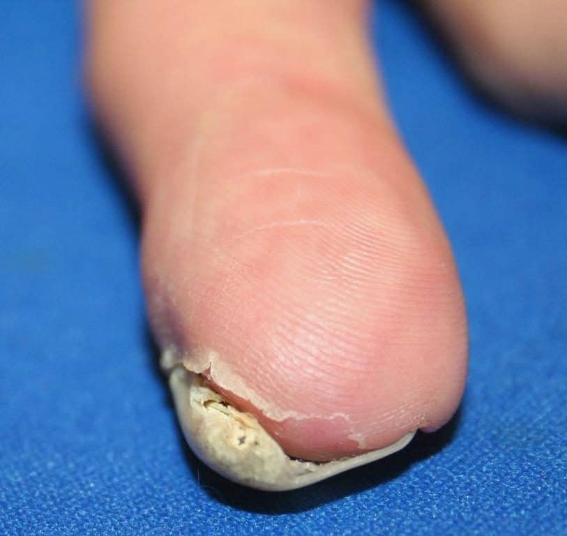 Ventral Pterygium of Nail