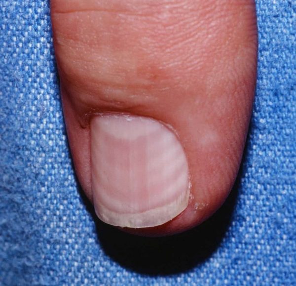Muehrcke's Lines - nail white line