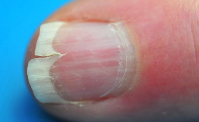 Split Fingernails Onychoschizia Symptoms Causes Remedies