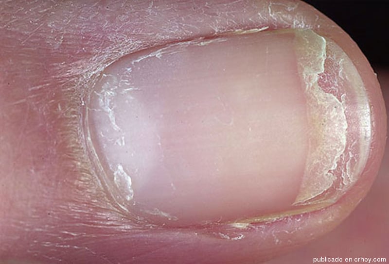 onychoschizia nail splitting