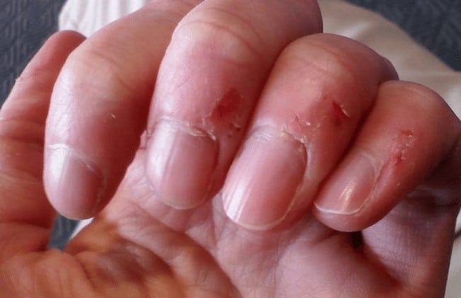 how-to-stop-peeling-fingertips-peeling-nails-peeling-cuticles