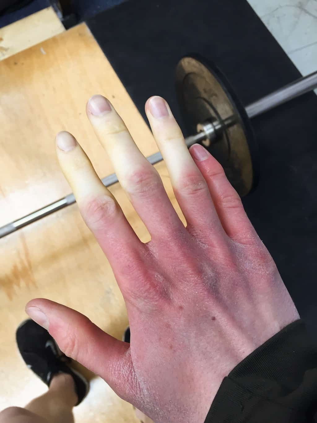 raynaud syndrome