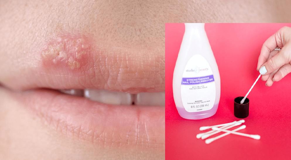 Can You Get Rid of Cold Sore With Nail Polish Remover?