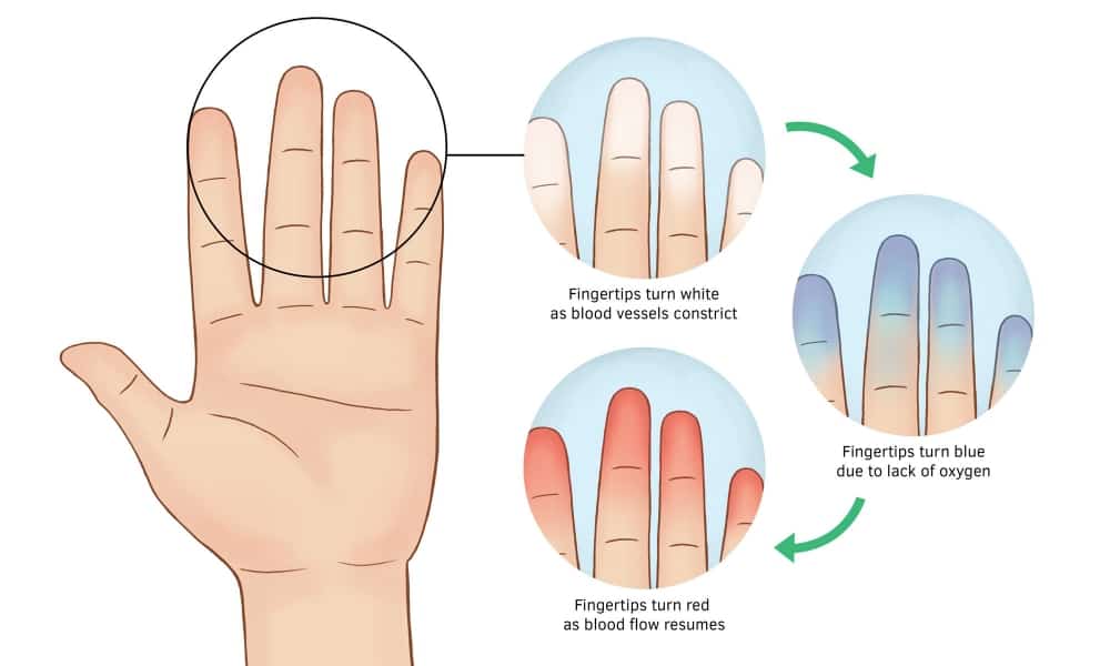 Raynaud's Syndrome