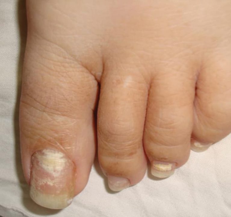 White Superficial Onychomycosis: Types, Symptoms, Causes & Treatment