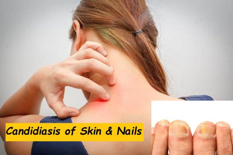 Candidiasis of Skin and Nails: Causes, Symptoms & Treatments