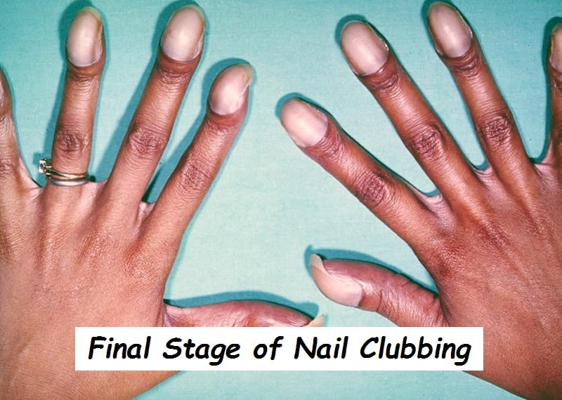 Nail Clubbing Signs Stages And Treatment Naildesigncode