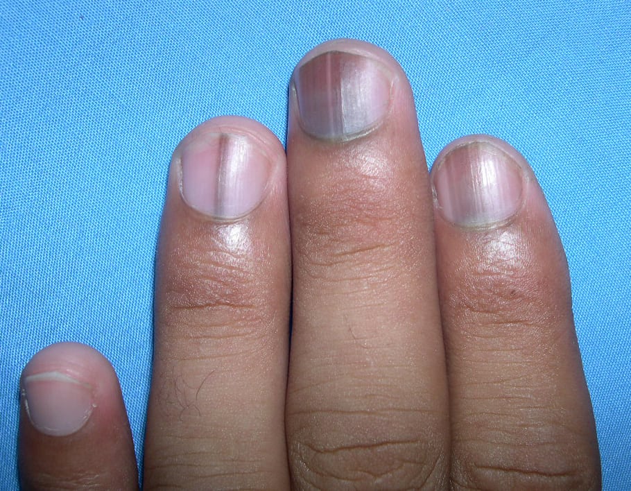 Melanonychia on nails