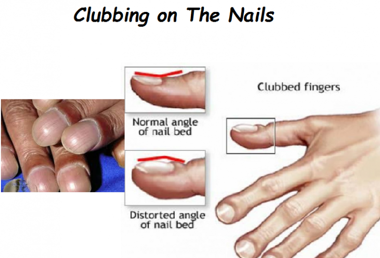 Nail Clubbing Signs Stages And Treatment NailDesignCode nail-clubbing-signs-stages-and-treatment-naildesigncode