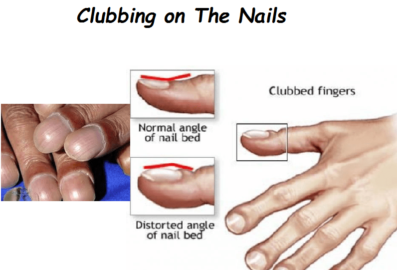 Nail Clubbing Signs Stages And Treatment Naildesigncode