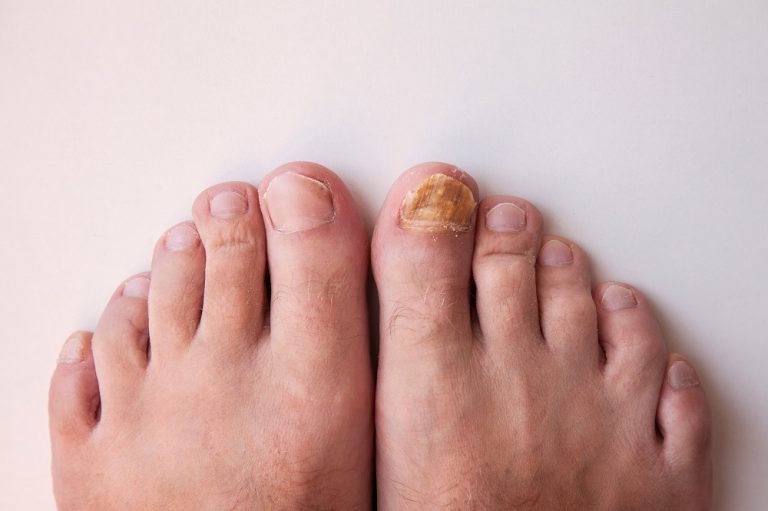 Brown Spot on the Toenail: Causes and Treatment