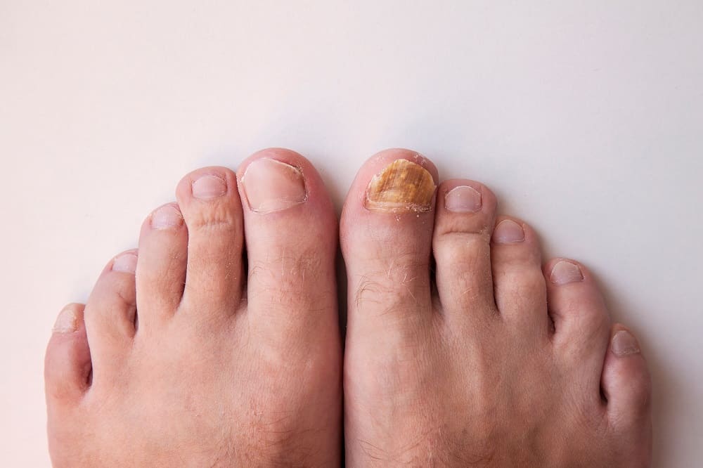 Brown Spot on the Toenail: Causes and Treatment