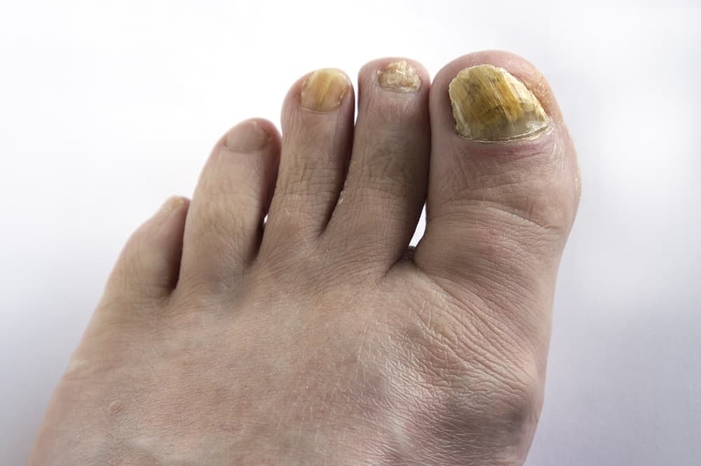 What Causes Thick Toenails - Fungus