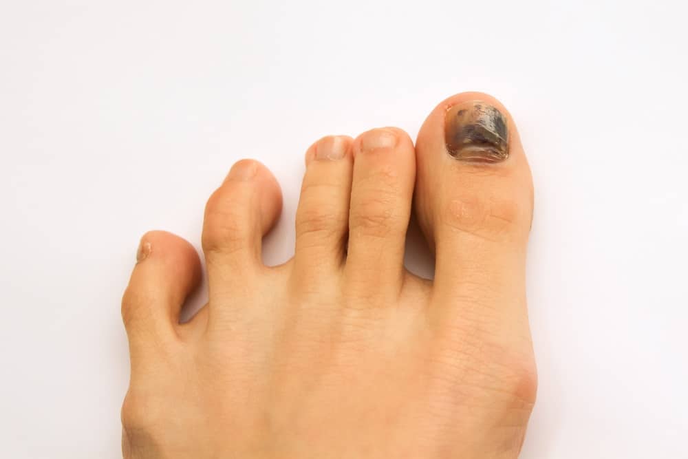 What Causes Thick Toenails - Injury