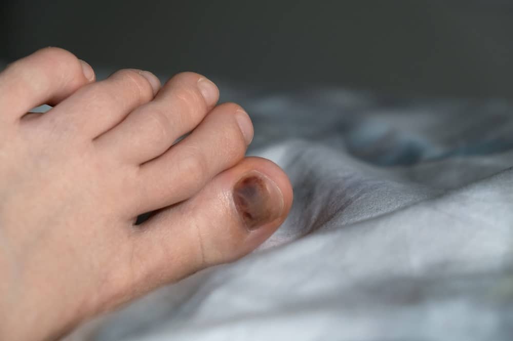 brown spot on toenail reason- Injury