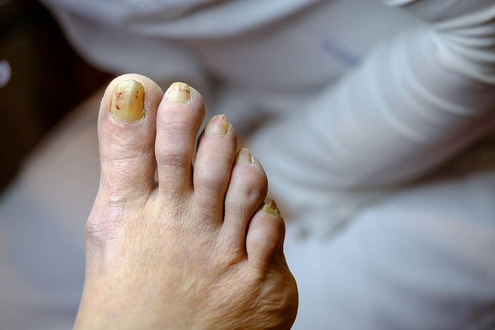 brown spot on toenail reason- Medication