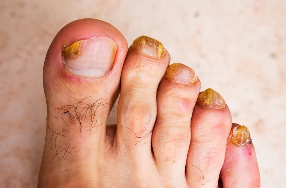 brown spot on toenail reason- Nail Fungus