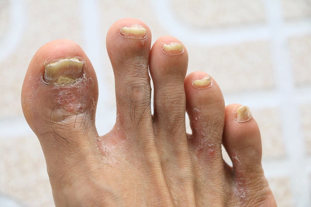 brown spot on toenail reason- nail psoriasis