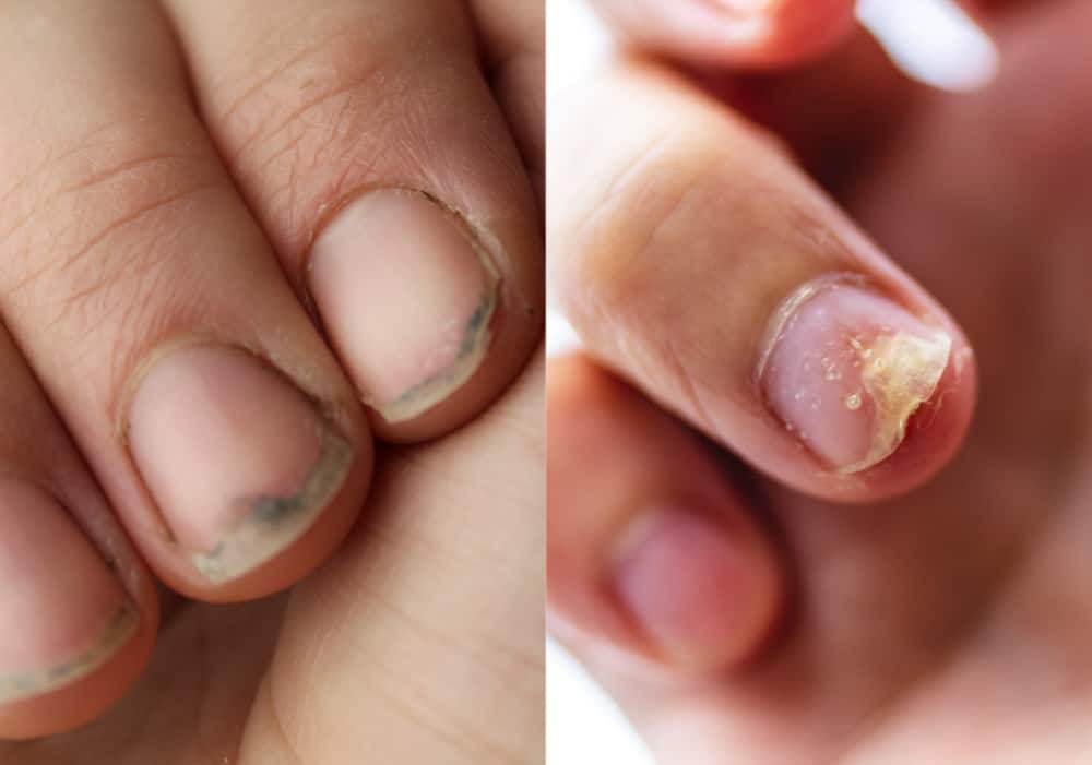 Causes of Fanned Nail